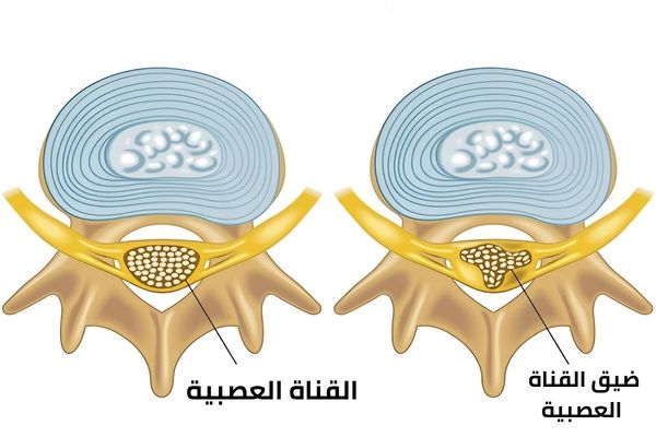 علاج ضيق القناة العصبية
